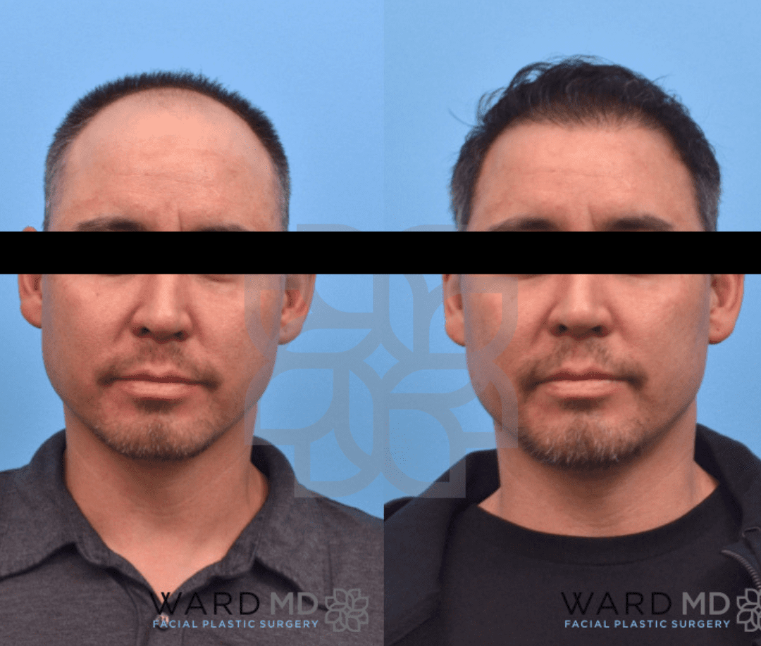 hair transplant before and after patient